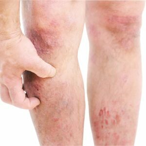 eczema on legs images