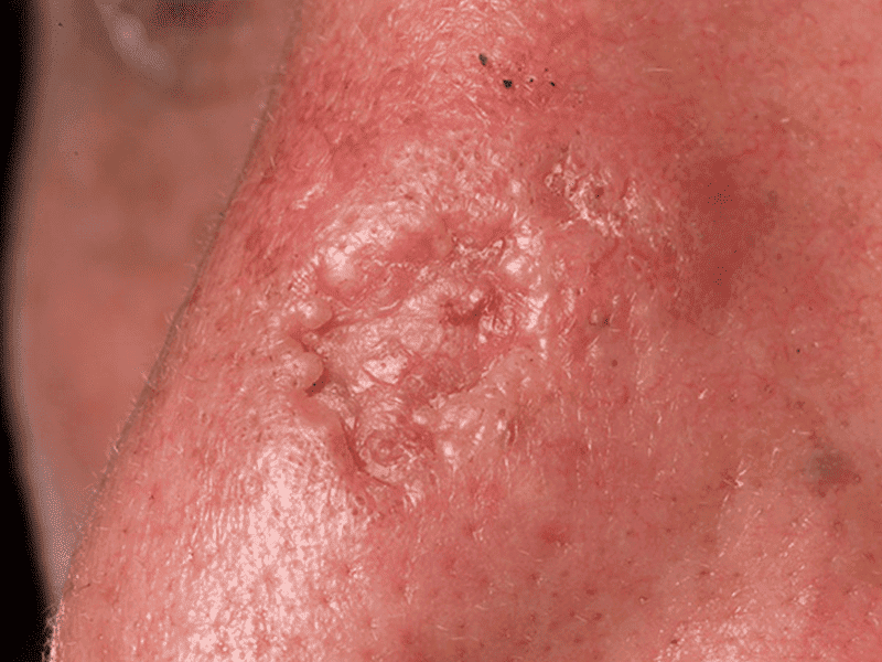 Basal Cell Carcinoma St Michaels Clinic