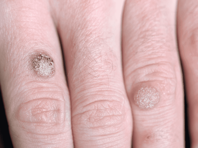 Warts and Verrucas - St Michaels Clinic