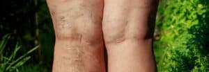 varicose veins treatment