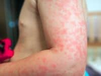 skin allergy symptons