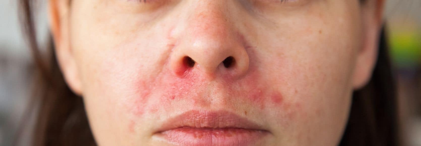 atopic dermatitis eczema